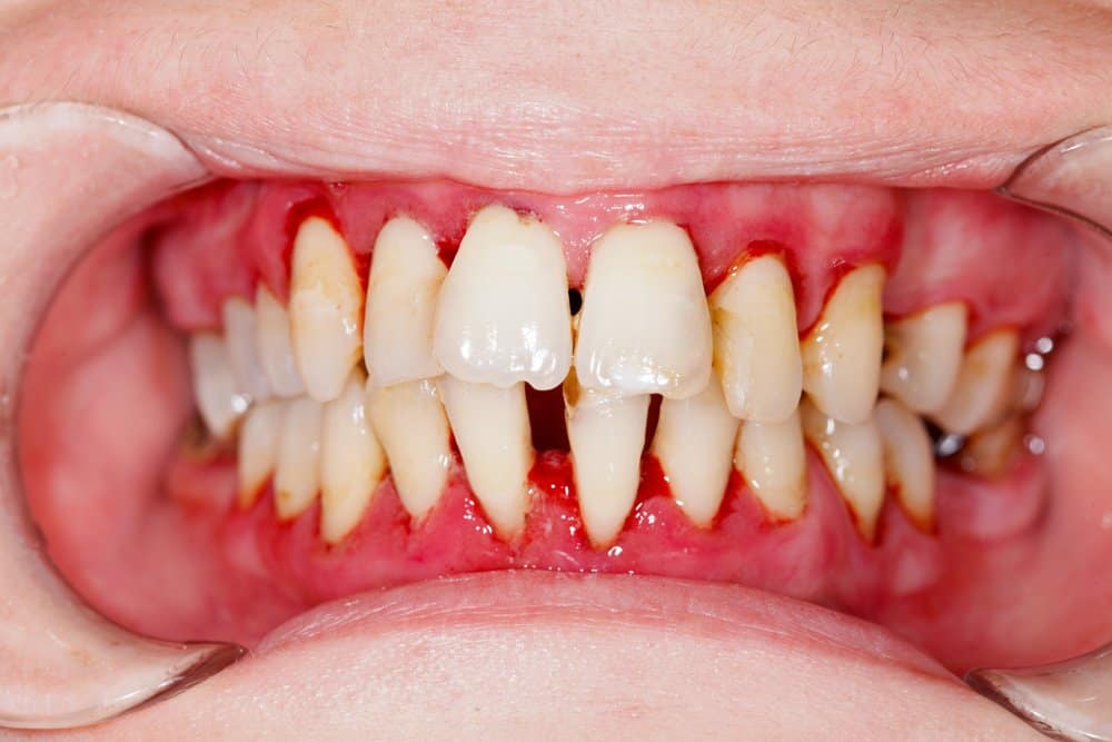 Gum bacteria and Alzheimer’s disease: Unravelling the connection